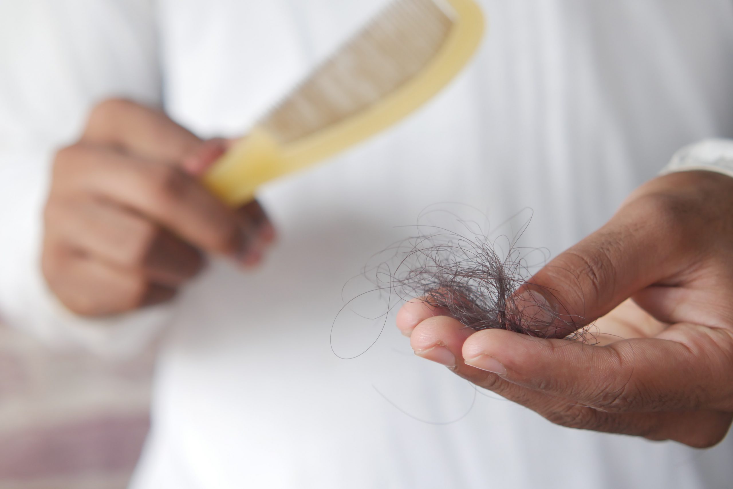 Imagen de un peine con cabello femenino, que muestra el excesivo derramamiento de cabello asociado con la alopecia femenina
