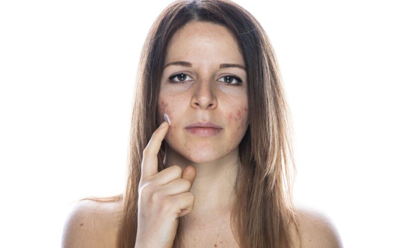 cicatrices-acne-profundas-guia-tratamiento