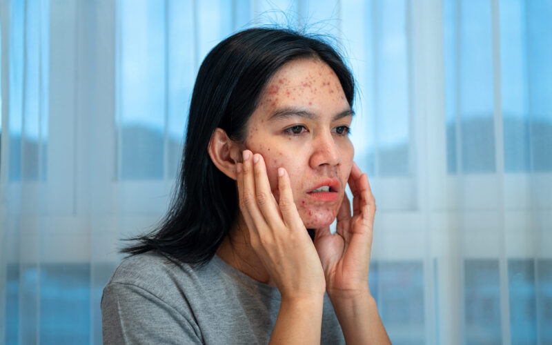acne-quistico